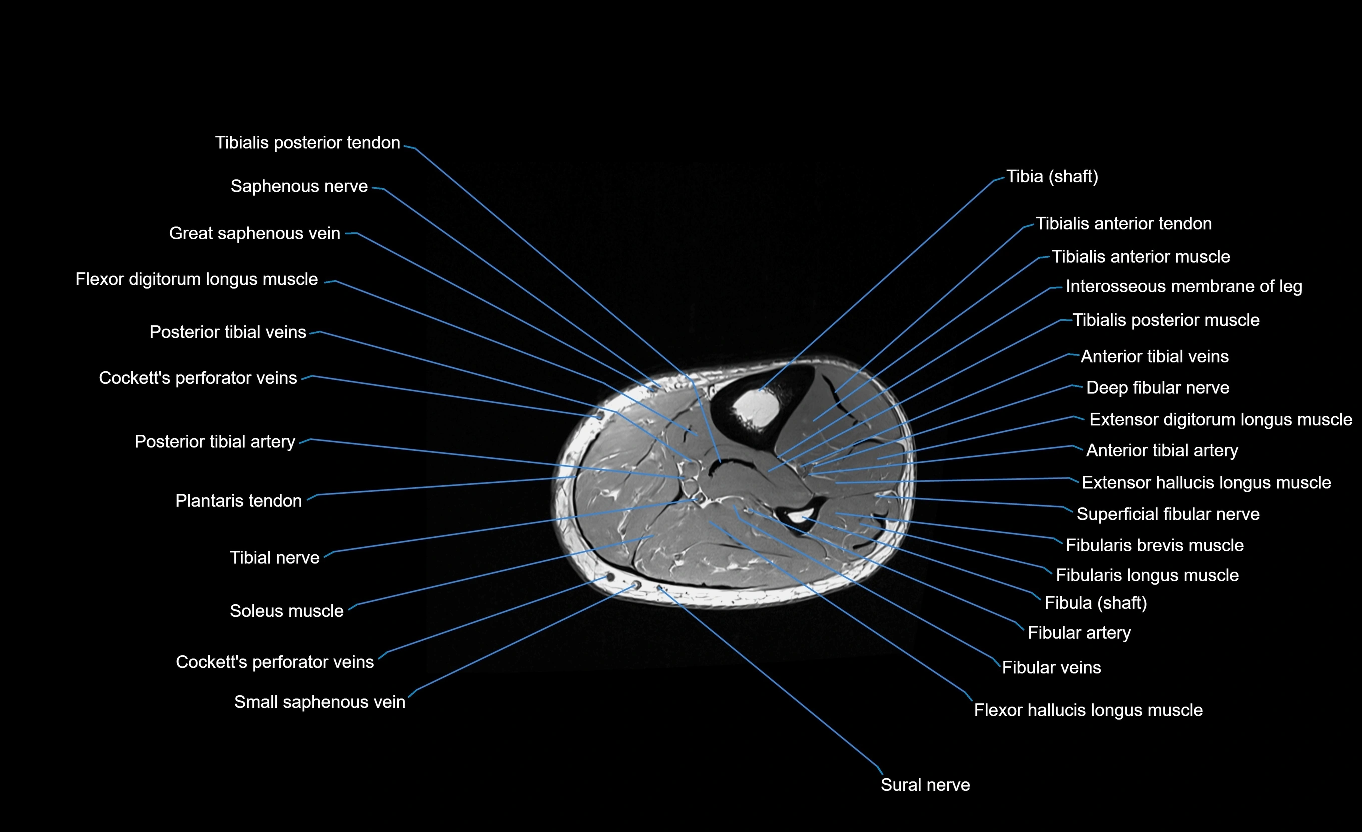 MRI lower leg axial cross sectional anatomy 3T  radiology  image-img-00001-00057.webp